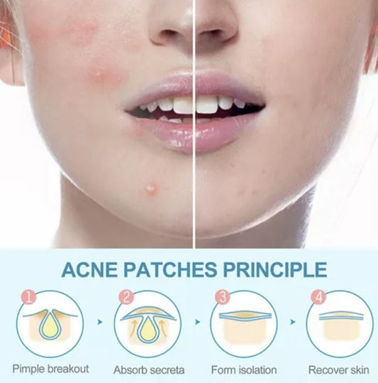 Parche antiacné.