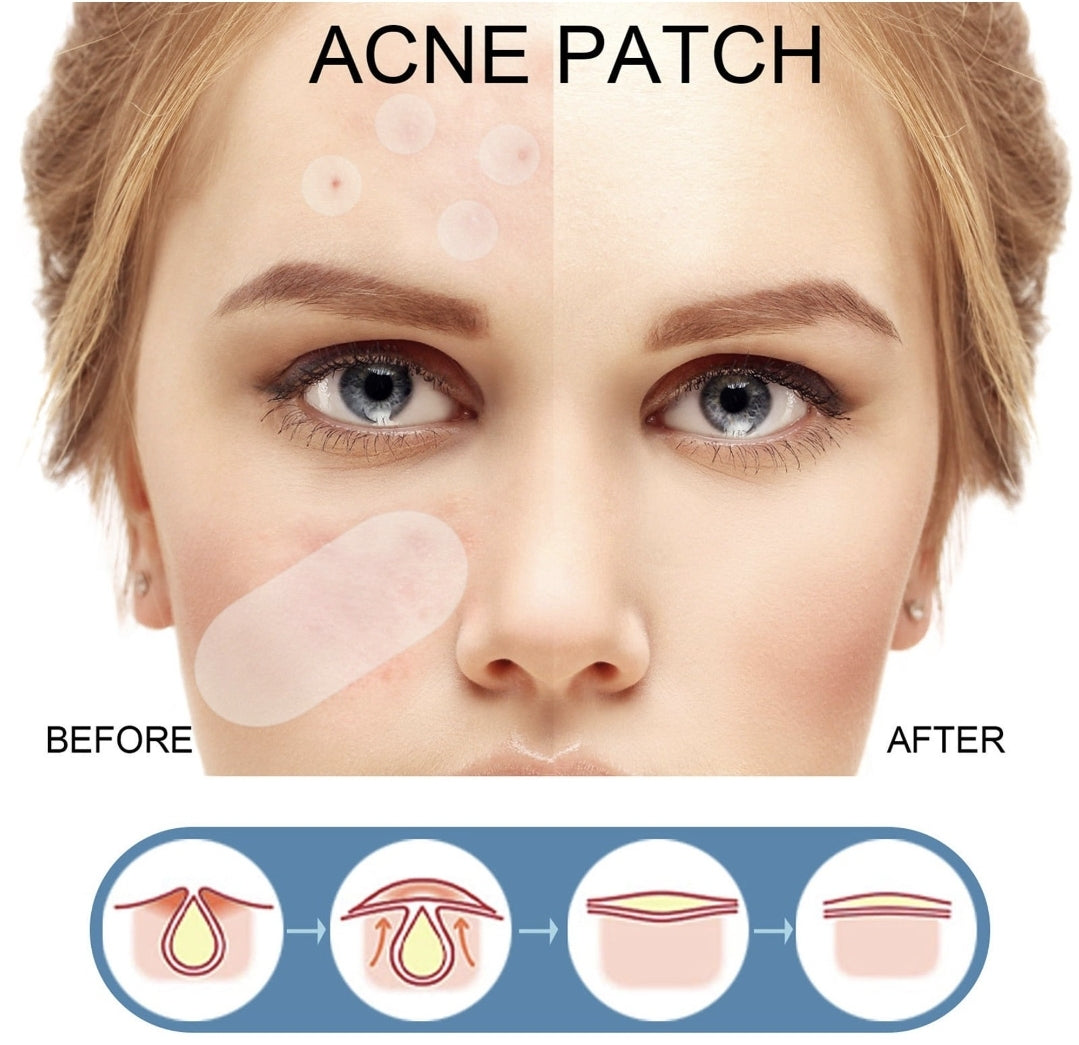 Parche antiacné.