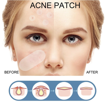 Parche antiacné.