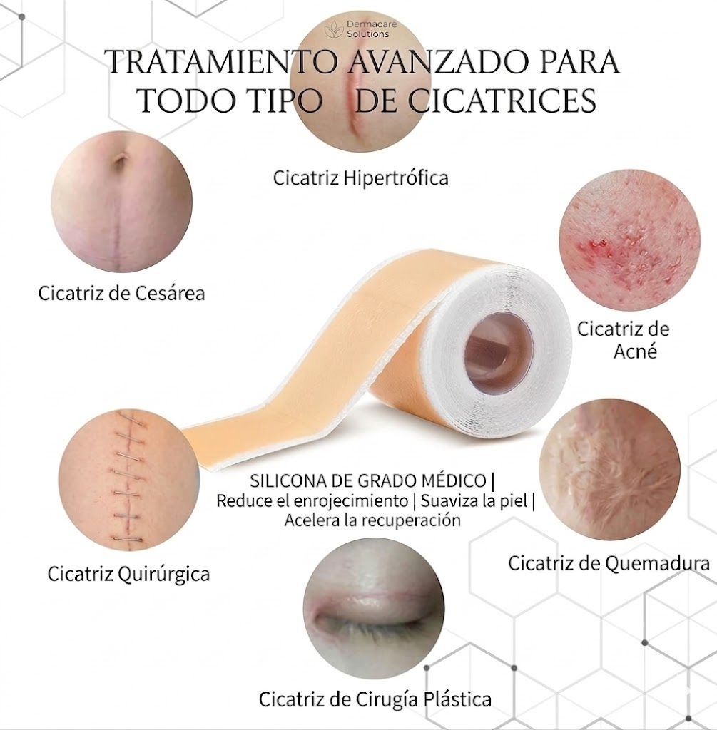 Tratamiento Efectivo y Cómodo para Todo Tipo de Cicatrices: Rollo de Cinta de Silicona de Grado Médico